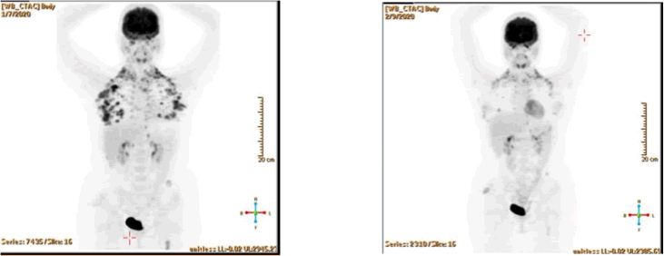 Phase II Bisantrene trial data published in European Journal of Haematology